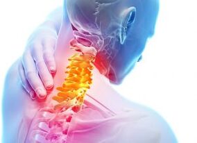Bol i skloništa u zoni cervikale s trećim stupnjem osteohondroze