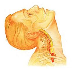 Osteohondroza vratne kralježnice