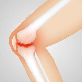 artroza je neupalna patologija zglobova